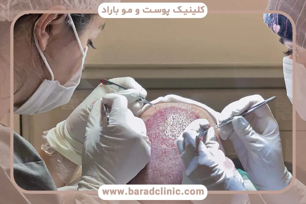 کاشت مو با نیدل چقدر درد دارد؟ بررسی کلی درد