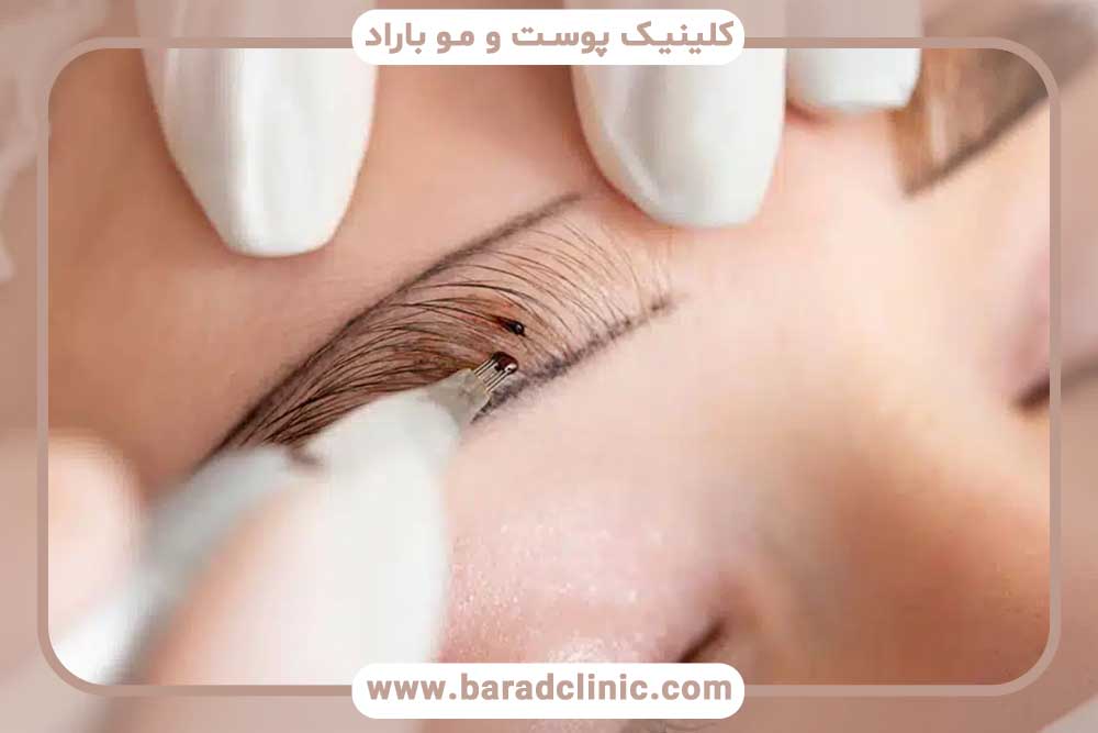 کاشت ابرو با فیبروز ابرو
