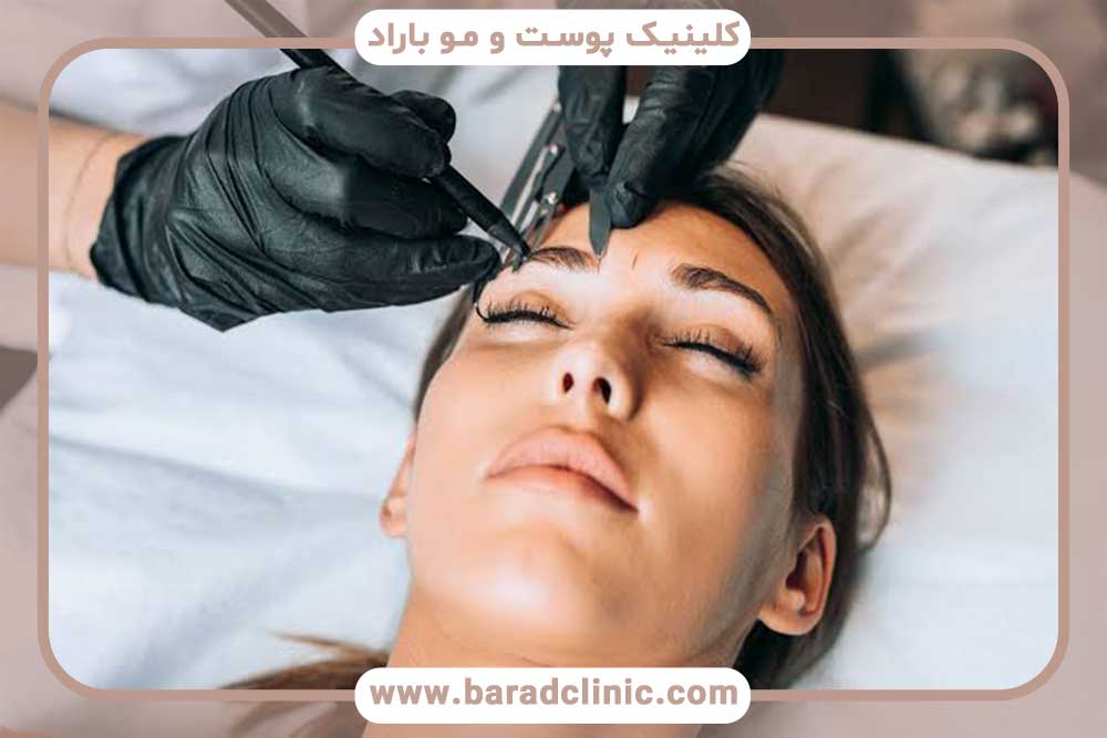 میکروبلیدینگ ابرو