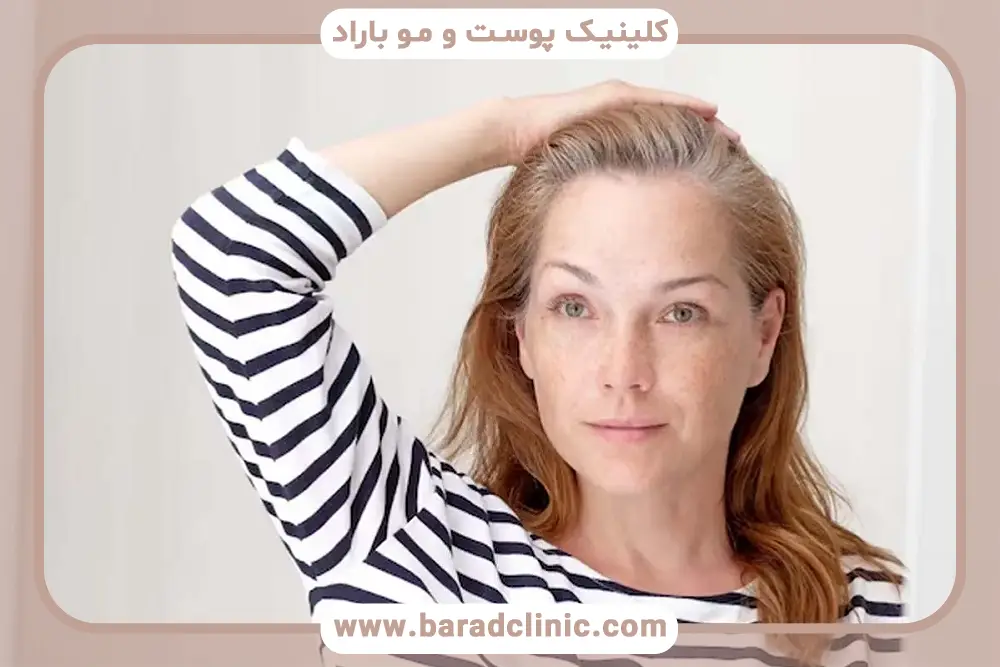 اهمیت عکسهای کاشت موی زنان