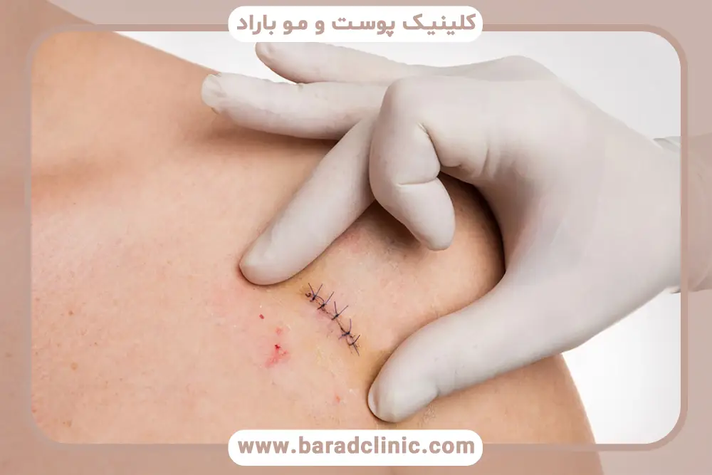 مزوتراپی جای بخیه چیست؟