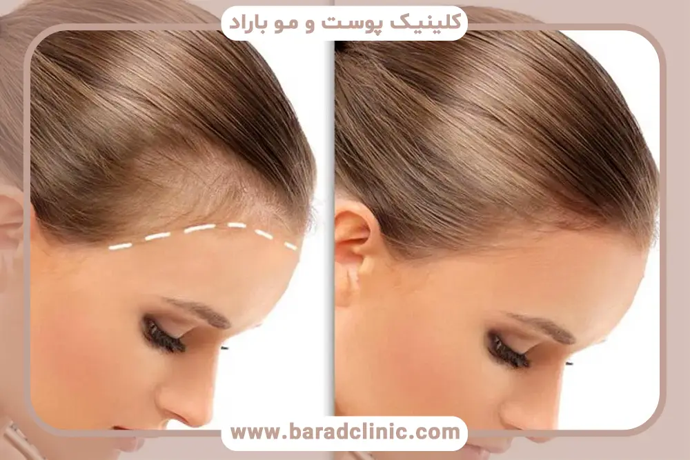 تفاوت عوارض کاشت مو در زنان و مردان
