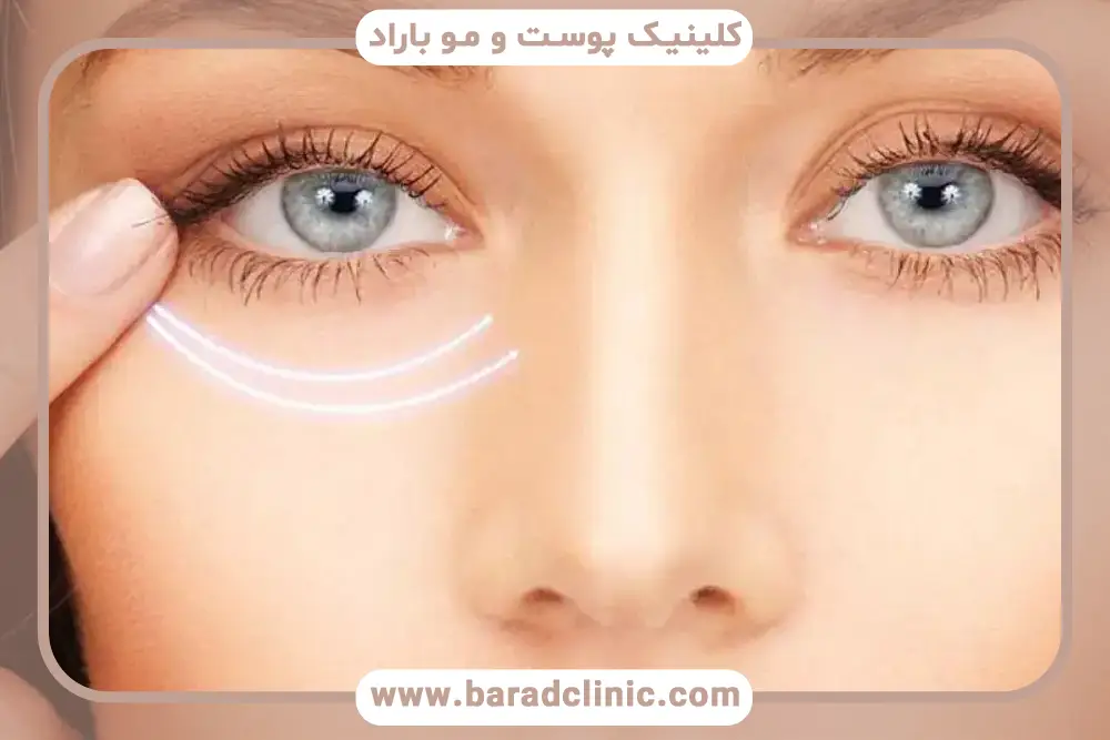 بلفاروپلاستی پلک بالا و پایین به صورت همزمان چیست؟