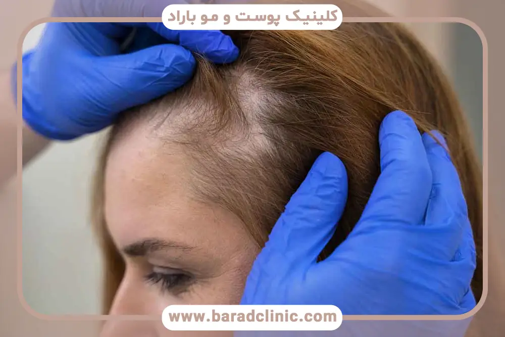 درمان ریزش مو زنان در خانه با ماینوکسیدیل