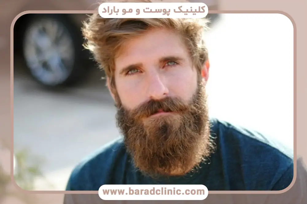 بررسی علت تغییر رنگ ریش 