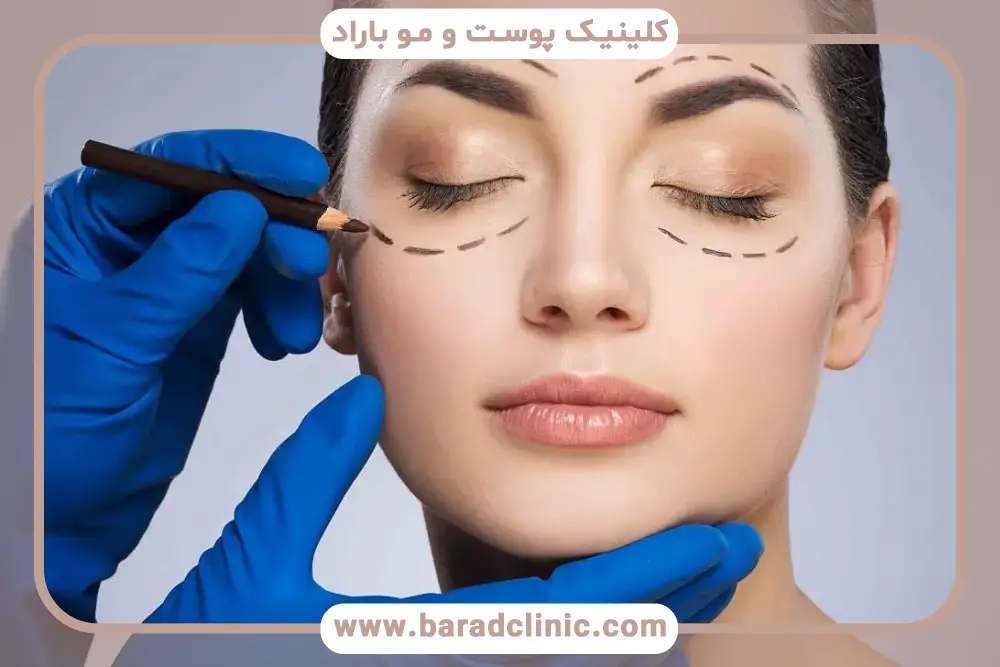 ترمیم عمل بلفاروپلاستی چیست؟