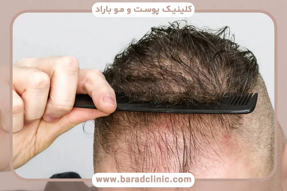 کدام ریزش مو خطرناک است؟ ریزش موی طبیعی