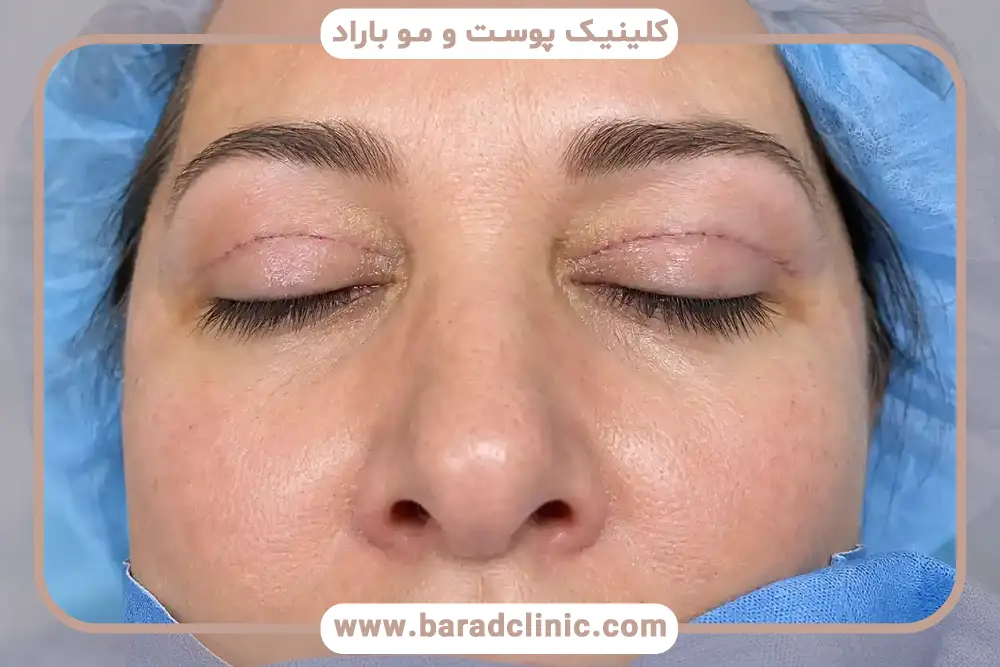 مهمترین مراقبت های بعد از عمل بلفاروپلاستی