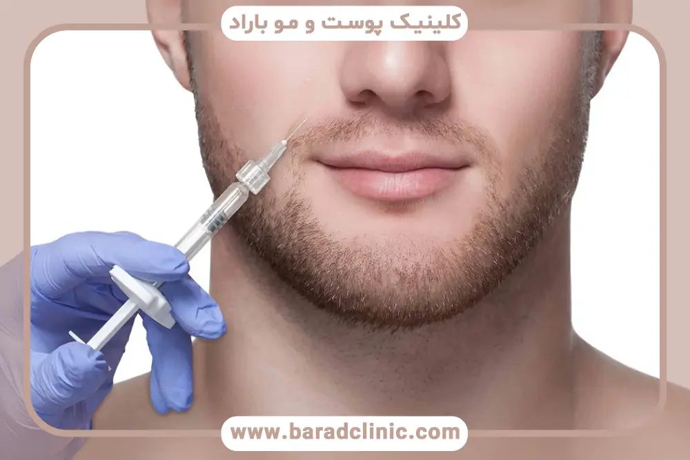 مزوتراپی ریش چیست؟