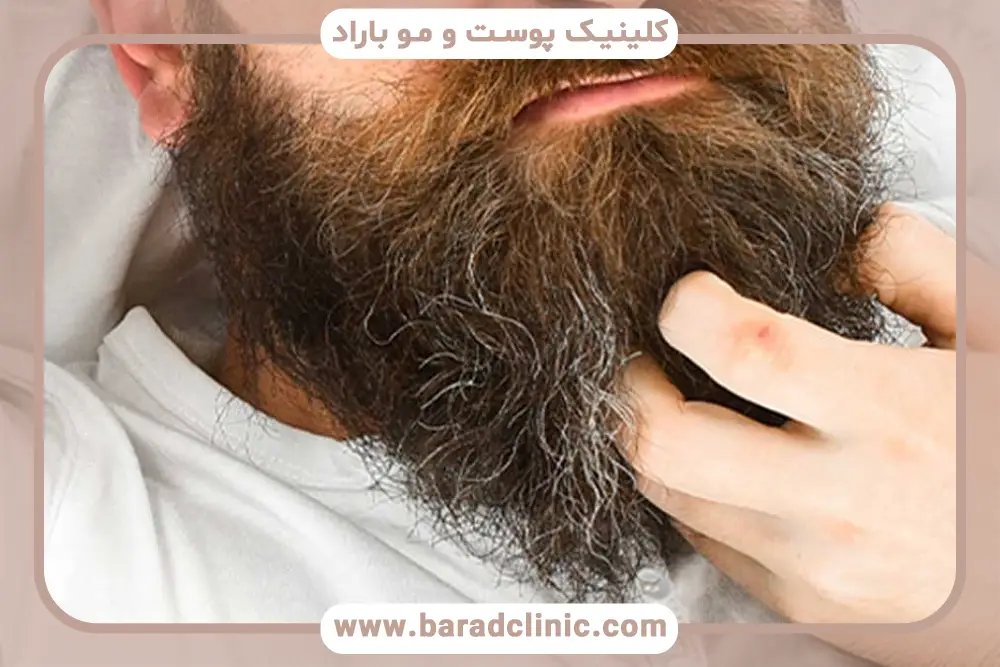 بررسی علت جوش های زیر ریش
