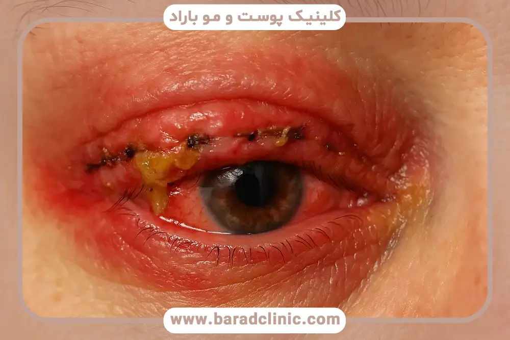 بررسی علائم عفونت چشم بعد از عمل بلفاروپلاستی