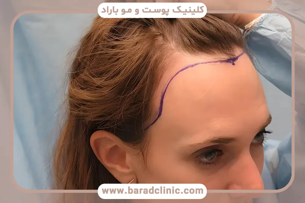 کاشت مو برای زنان چگونه است؟ بررسی کلی
