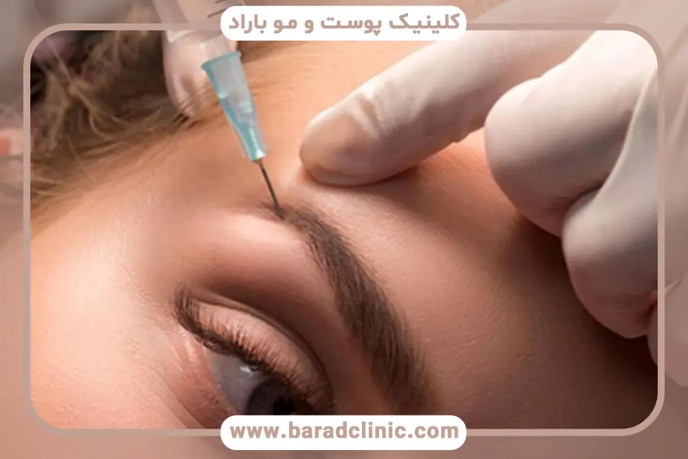 مزوتراپی ابرو درد دارد؟ بررسی کلی