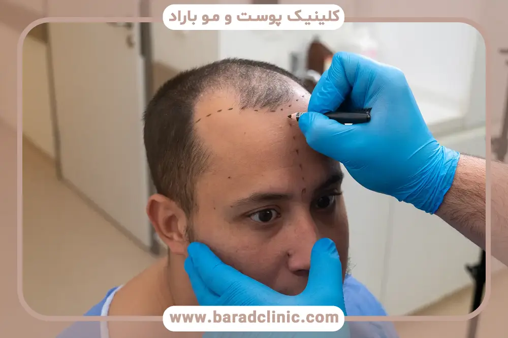 معرفی آخرین روش کاشت مو
