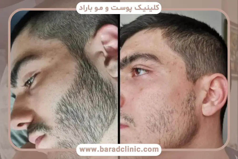 بررسی درمان ریش کم پشت