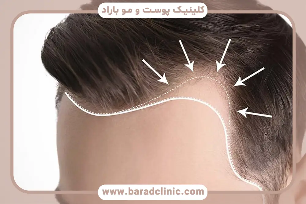 بررسی هزینه کاشت مو لیزری