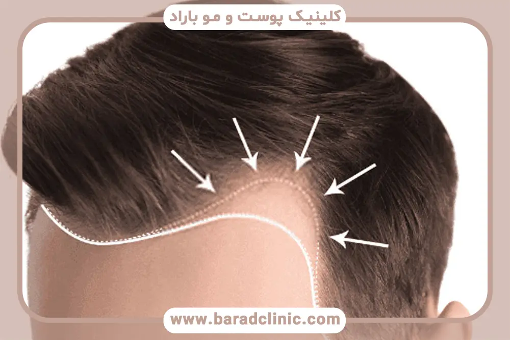 میانگین هزینه کاشت مو شقیقه