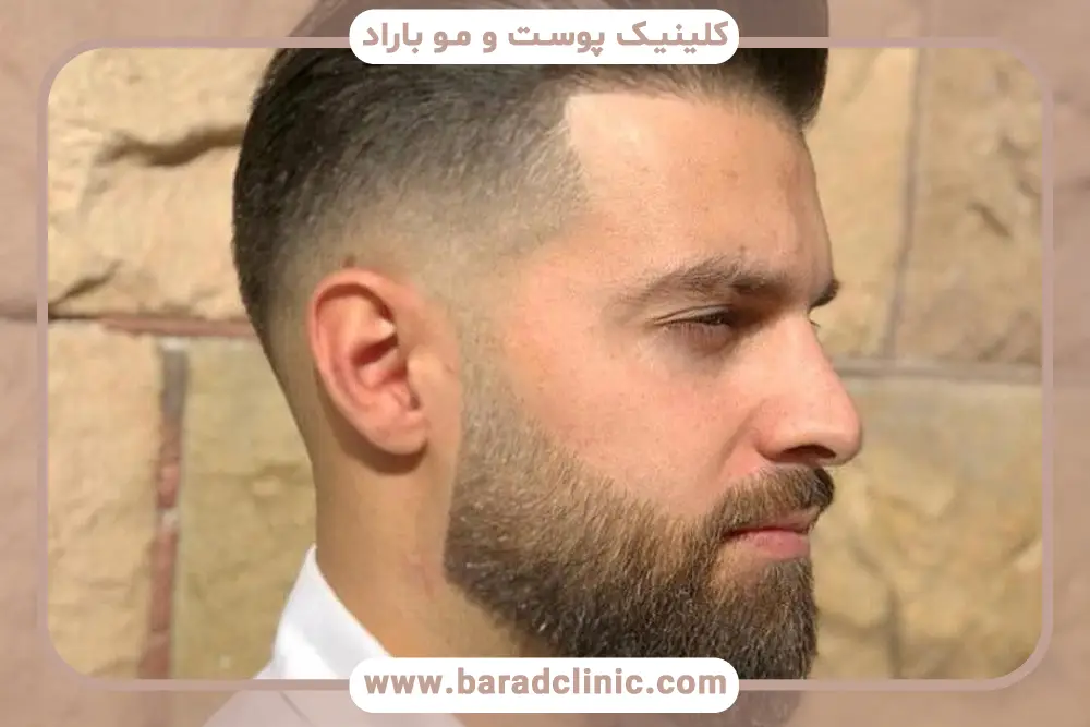 مراحل رشد ریش بعد از کاشت