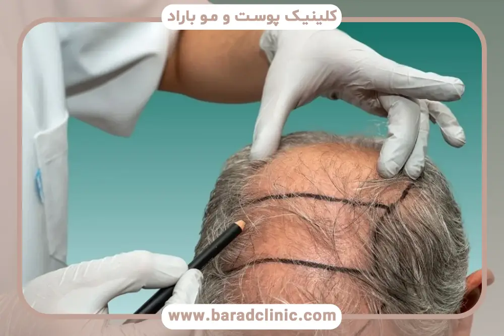 بررسی هزینه کاشت مو میکروگرافت