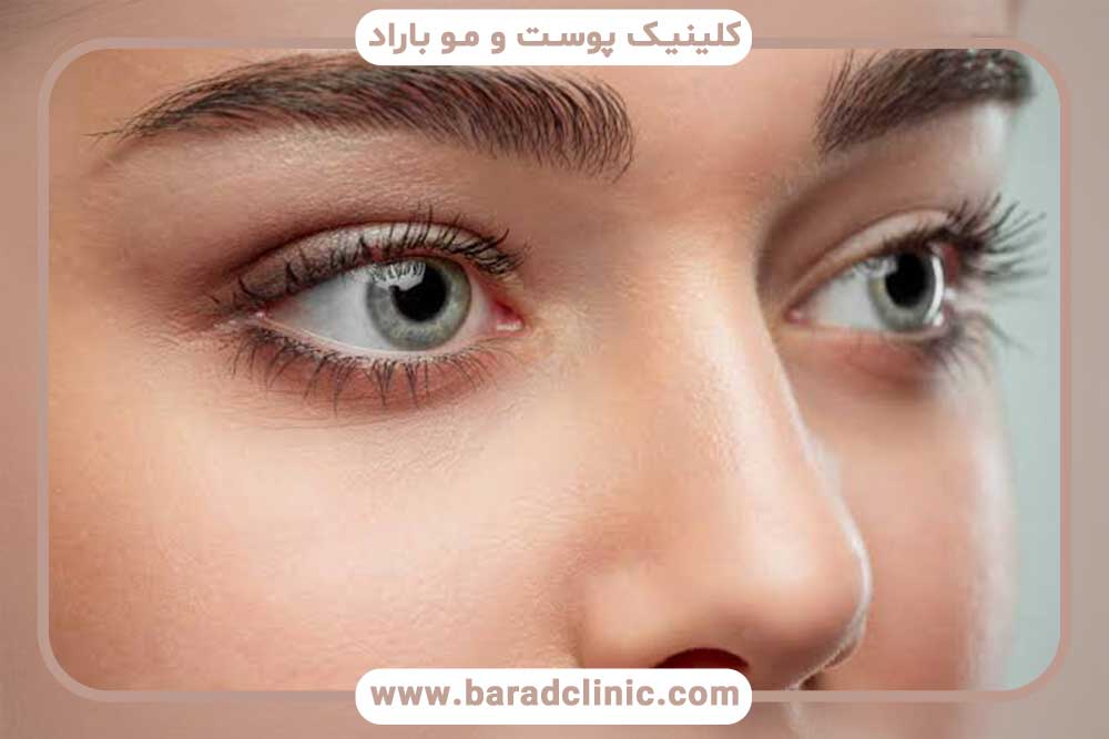 کاشت ابرو بدون جراحی