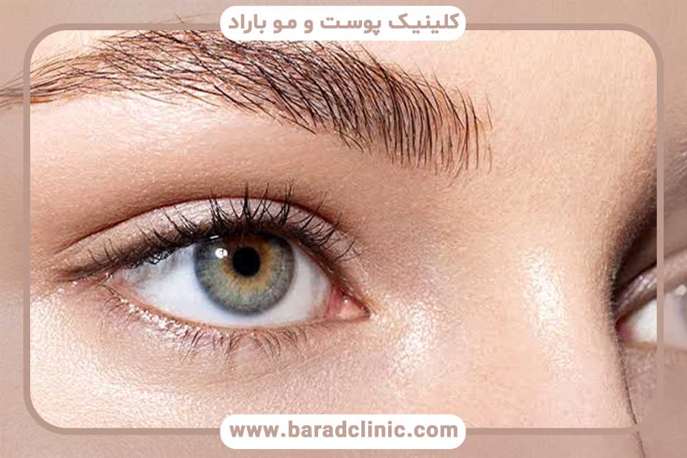 مراحل کاشت ابرو با جراحی