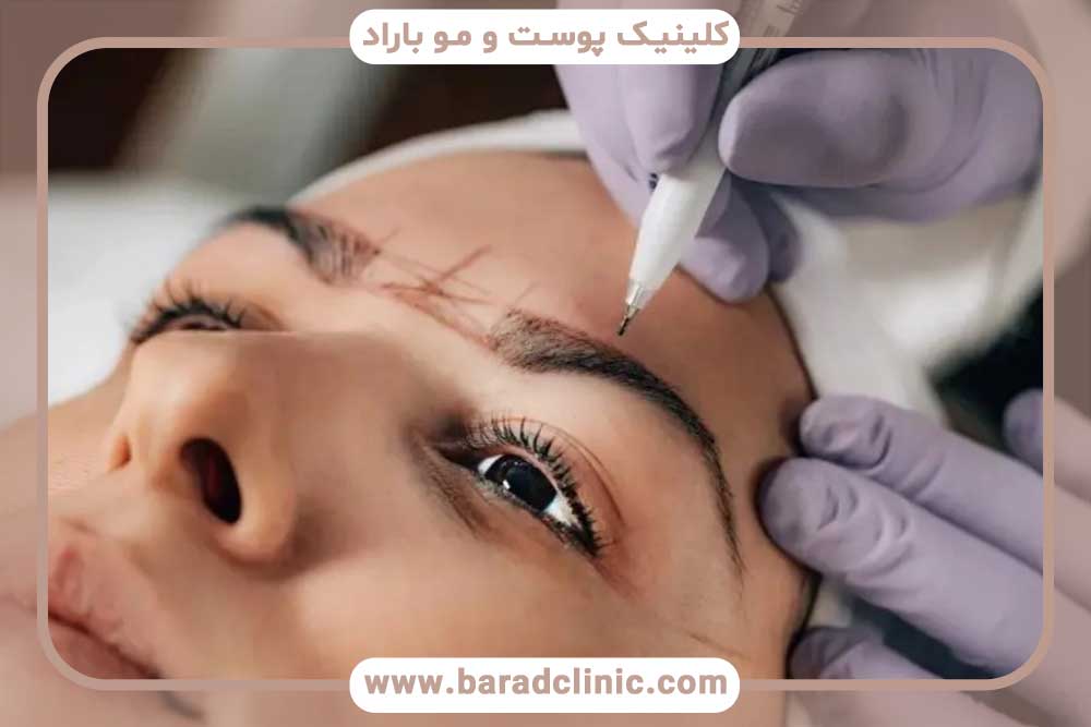 کم کاری تیروئید و کاشت ابرو