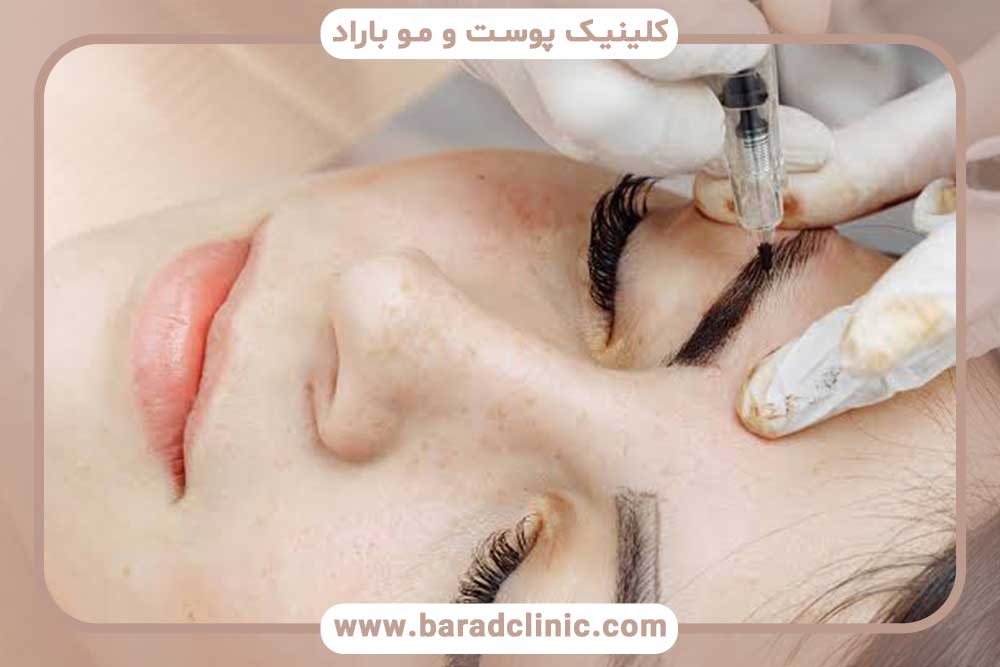 تفاوت میکروبلیدینگ و میکروپیگمنتیشن