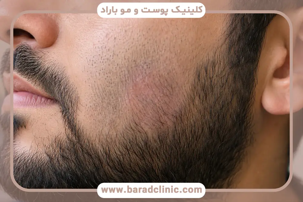 ریزش ریش طبیعی است؟ بررسی چرخه ریزش