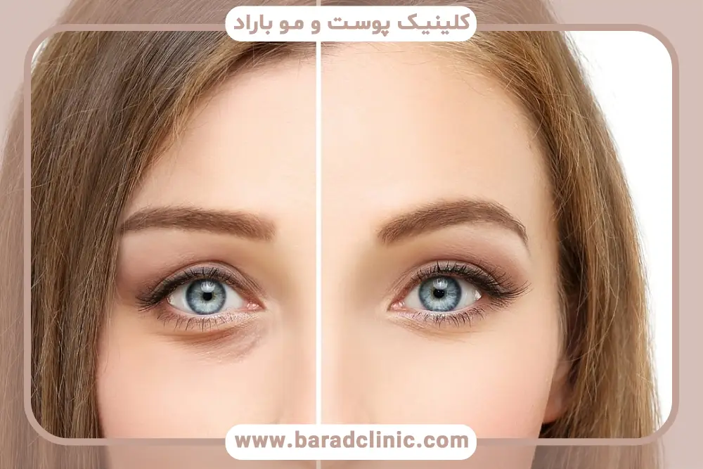 علائم ظاهری عمل ناموفق بلفاروپلاستی 