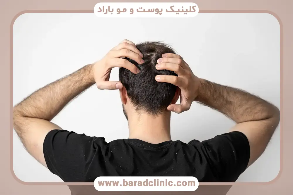بهترین روش کاشت مو برای پرپشت شدن 