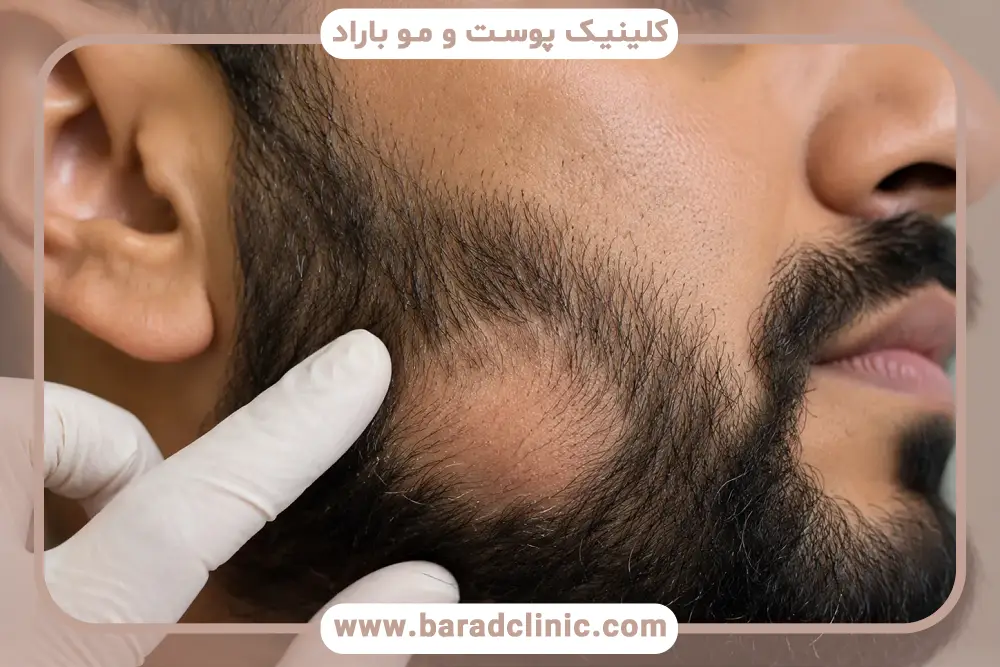 درمان ریزش ریش با اصلاح تغذیه
