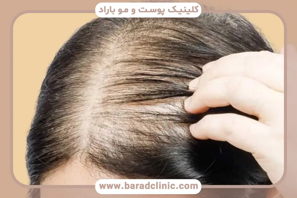 تامین ویتامین D برای درمان ریزش مو زنان در خانه