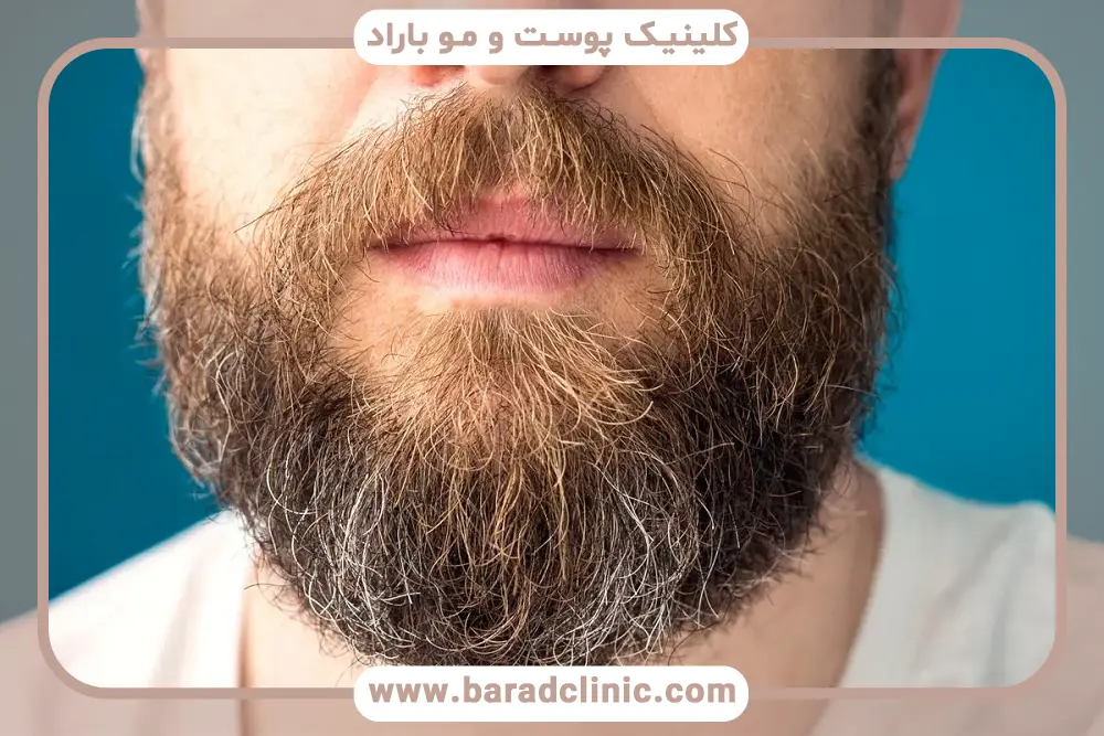 تغییرات هورمونی یک علت سفید شدن ریش 