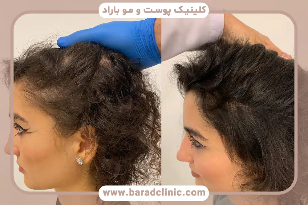 مزوتراپی جلوی سر برای ریزش ارثی