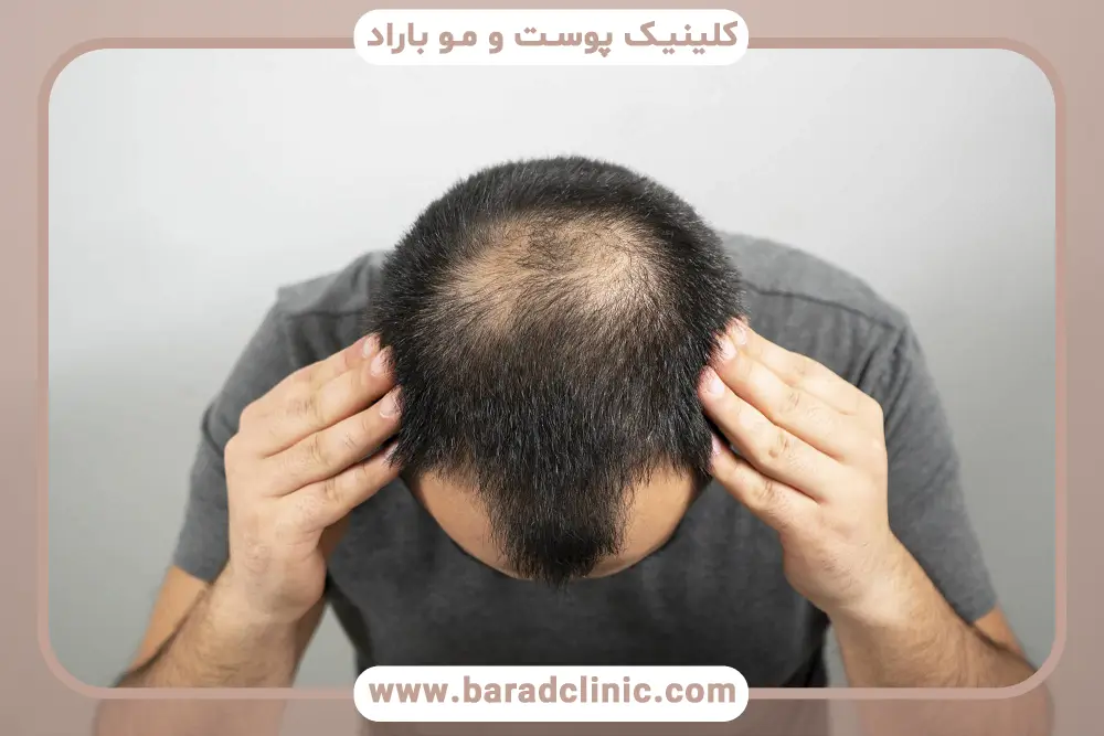 کدام ریزش مو خطرناک است؟ علائم هشداردهنده