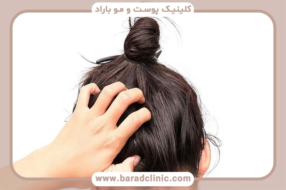 علت ریزش شدید مو در زنان بالا ی 50 سال