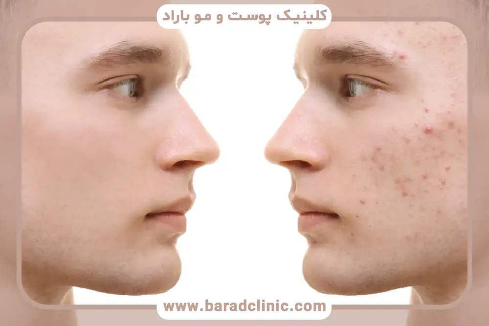 بیماریهای پوستی یک علت جوش های زیر ریش