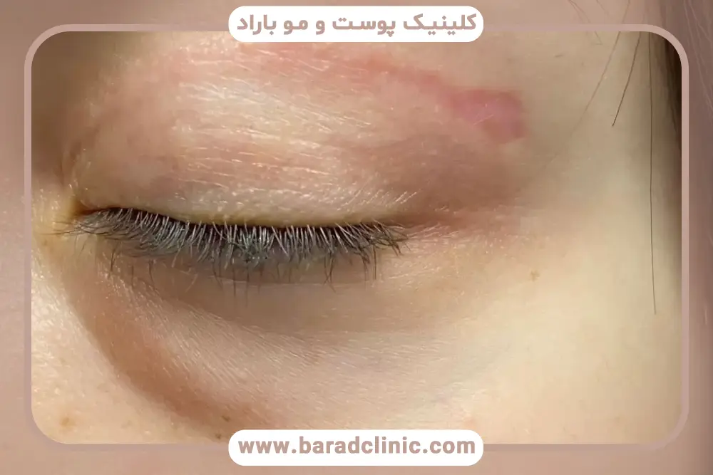 ترشح غیرطبیعی از علائم عفونت چشم بعد از عمل بلفاروپلاستی