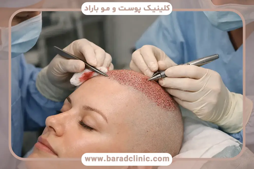 کاشت مو برای زنان چگونه است؟ مرحله مشاوره