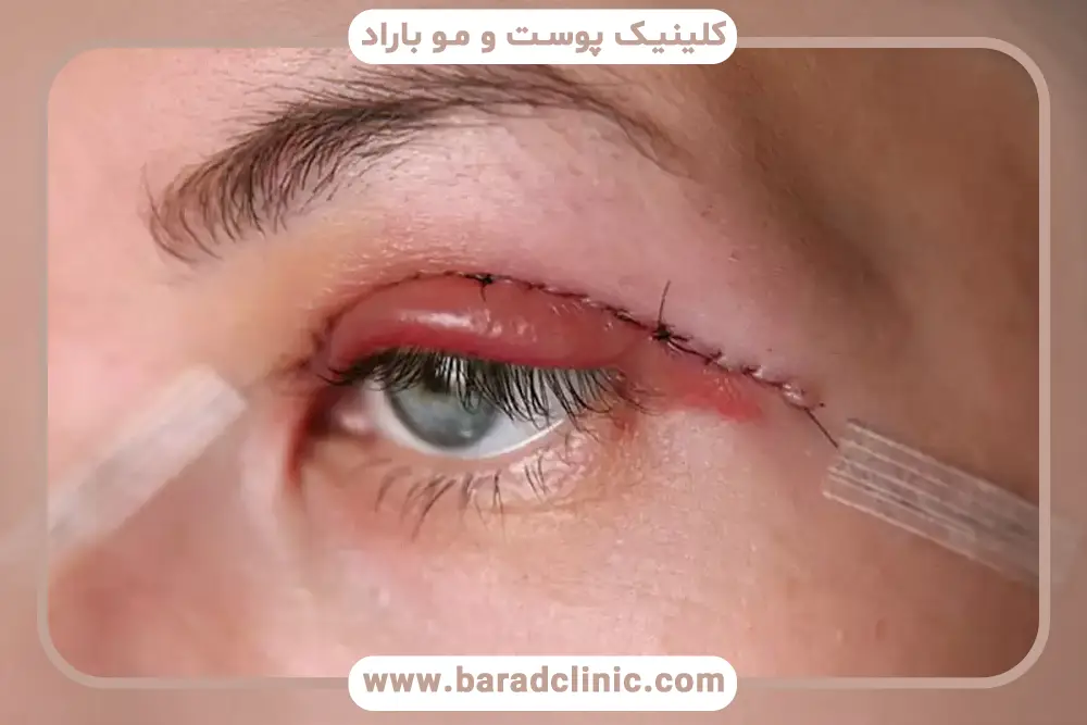 بررسی نحوه خوابیدن بعد از عمل بلفاروپلاستی 