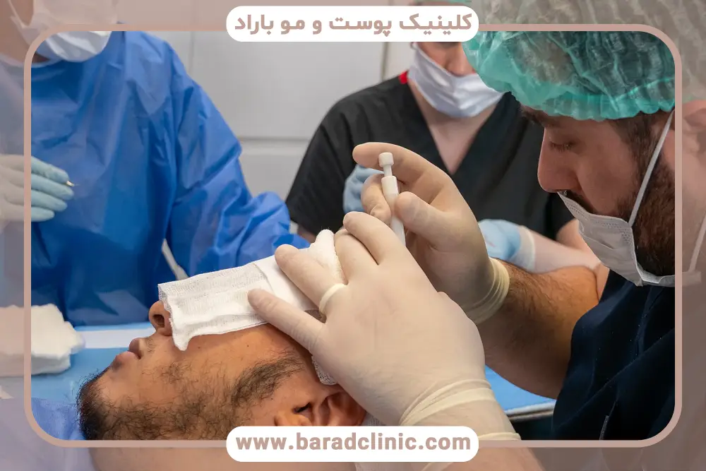بررسی تراکم آخرین روش کاشت مو