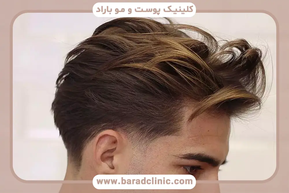 هزینه کاشت مو لیزری با روشهای مختلف