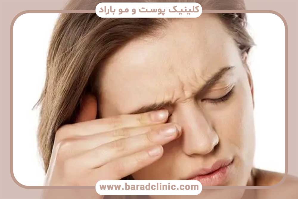 درد کاشت ابرو به روش fut