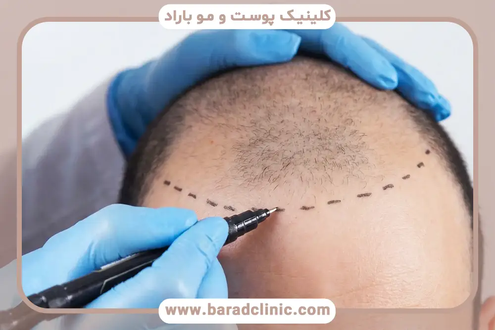 عوامل موثر بر هزینه کاشت مو شقیقه