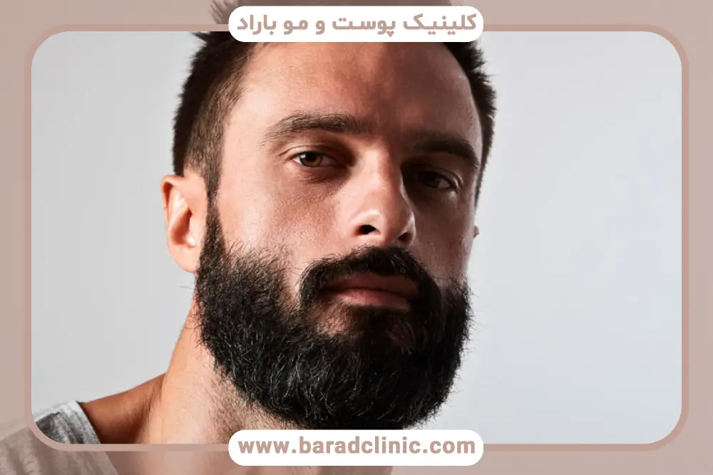شوک ریزش در فرایند رشد ریش بعد از کاشت