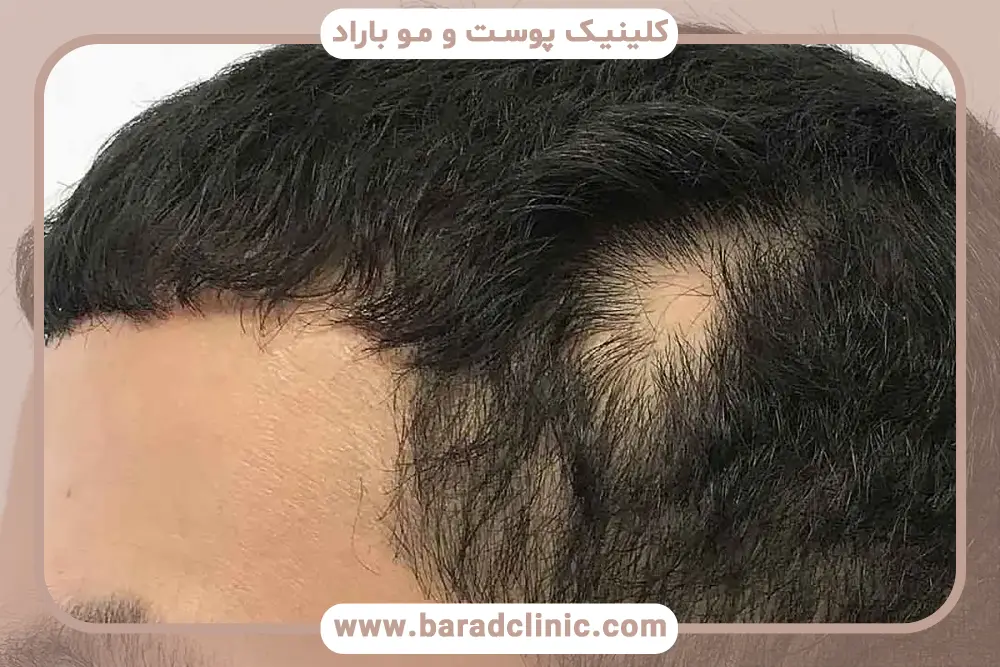 کمبود ویتامین و تاثیر آن روی ریزش مو 