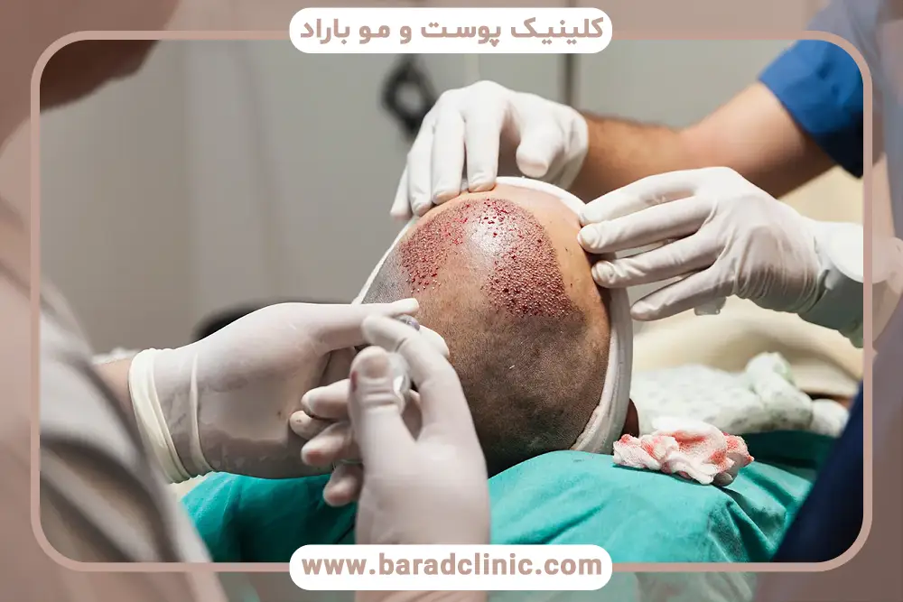 کاشت مو با نیدل چقدر درد دارد؟ عوامل افزایش دهنده درد