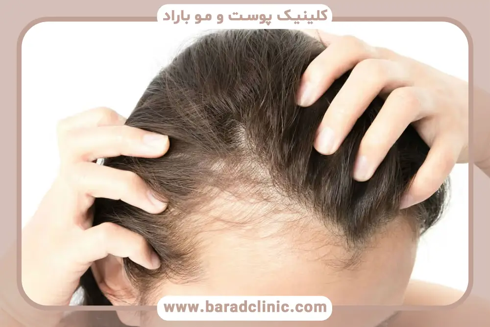 علت تفاوت هزینه کاشت مو در پیشانی زنان 