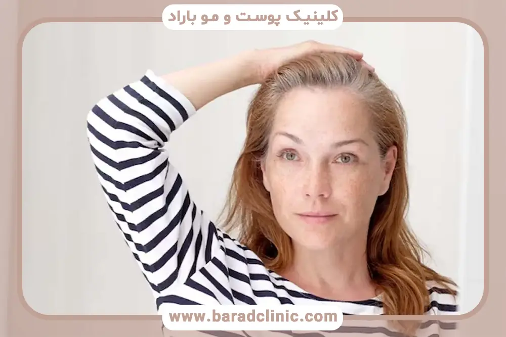 مراحل کاشت مو زنان بدون تراشیدن سر 