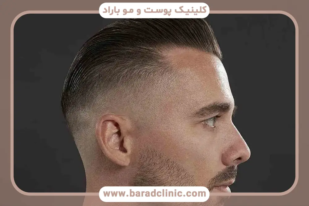 مراحل کاشت مو برای پرپشت شدن 